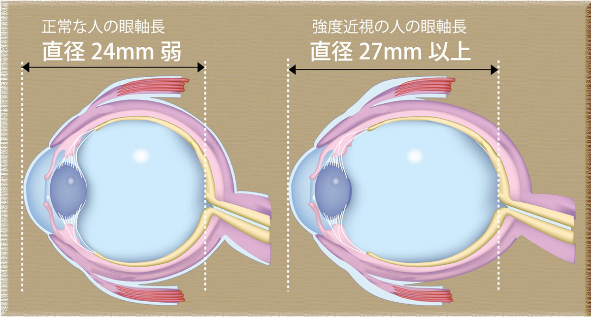 眼軸長による強度近視