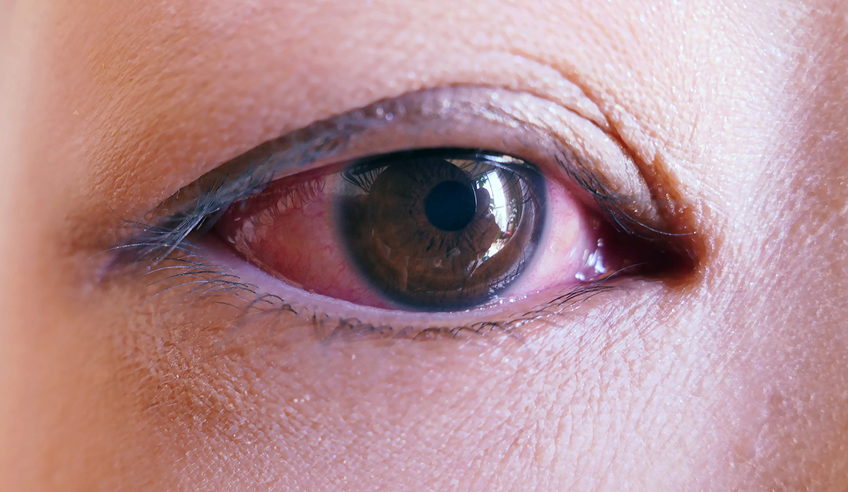 流行性角結膜炎は、角膜の炎症が強くなると視力低下の原因となることもある。