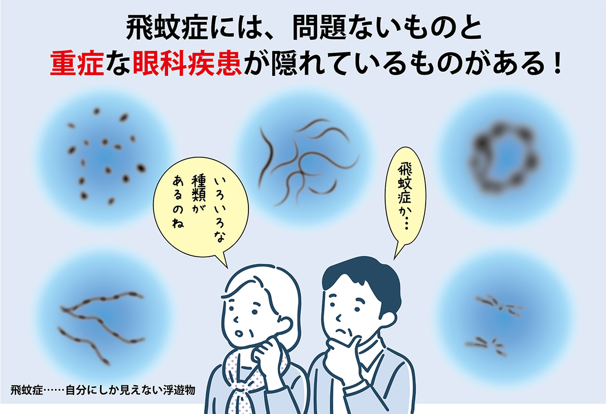 経過観察でよい「生理的飛蚊症」と治療が必要な「病的飛蚊症」。
