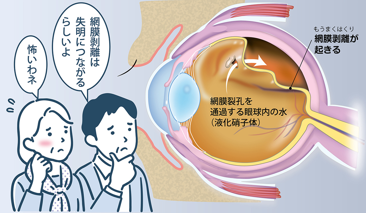 網膜裂孔・網膜剥離とは?　網膜剥離は失明につながるだけに、その初期症状を見逃さないことが大切!!