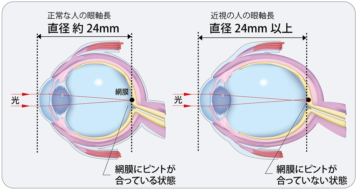 なぜ近視になると「眼軸長」が延びるのか?　眼軸長のイラスト。