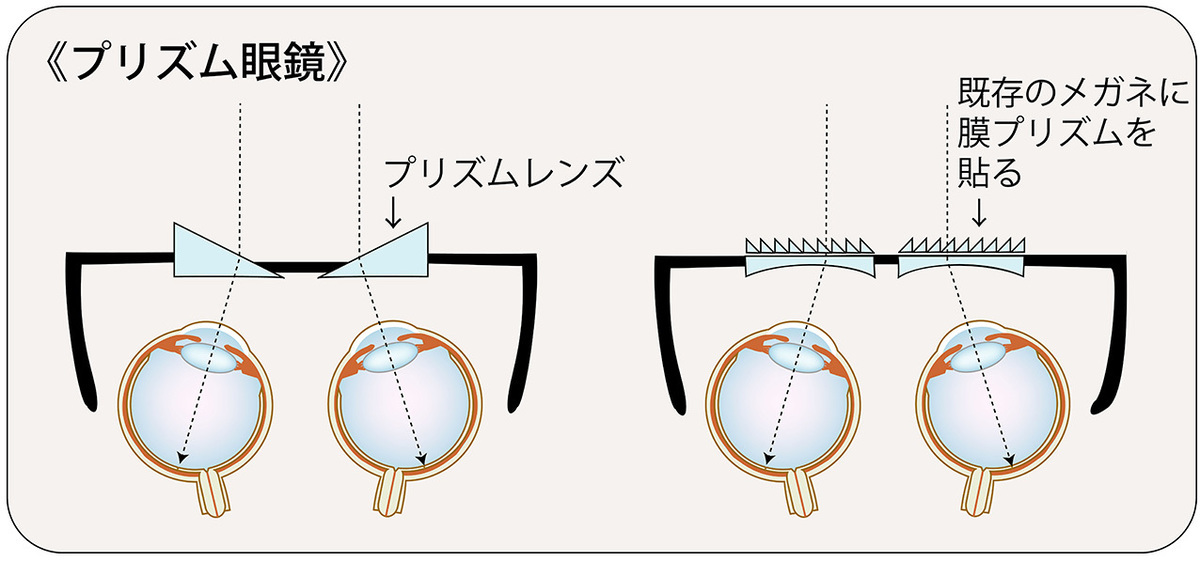 プリズム眼鏡の解説イラスト。プリズムレンズと膜プリズムを紹介。