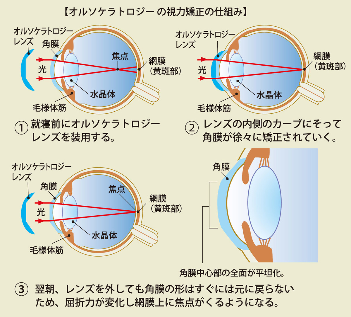 オルソケラトロジーの視力矯正の仕組み