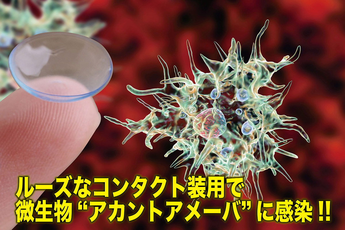 ルーズなコンタクト装用で微生物“アカントアメーバ”に感染!!