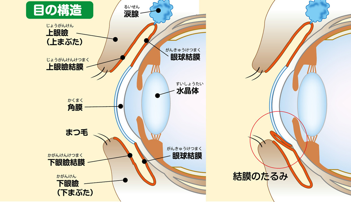 結膜弛緩の説明イラスト。目の構造。